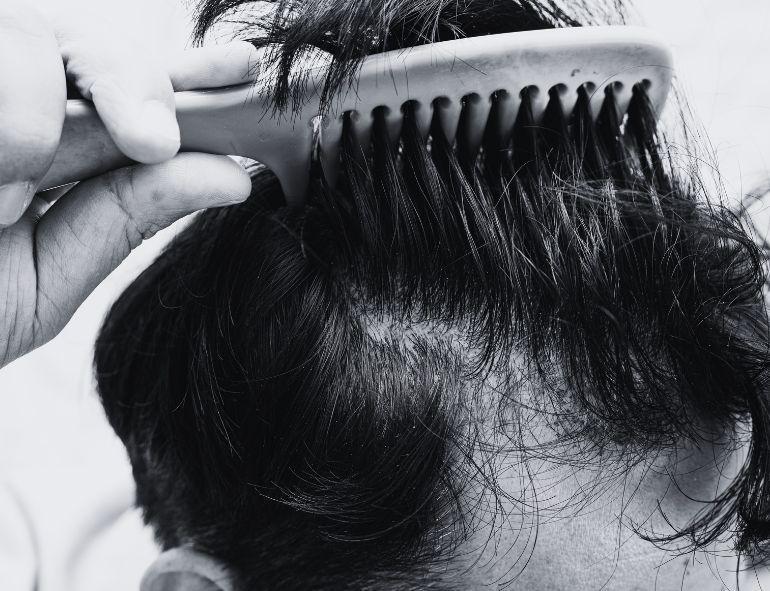 Unique Scalp Challenges for Asian Men